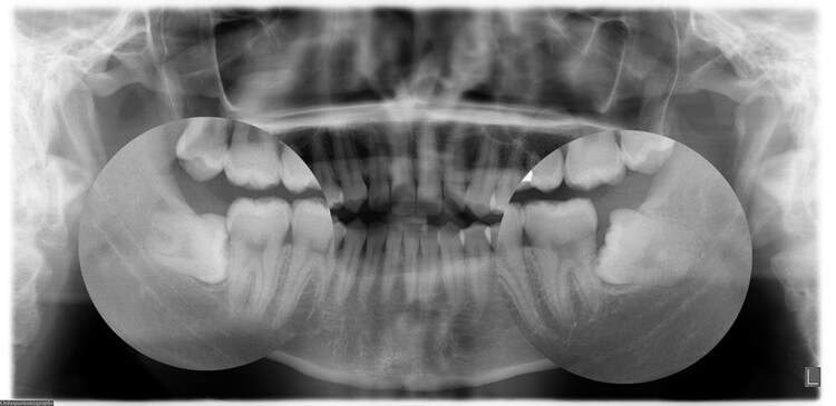 Wisdom Teeth Removal in Townsville