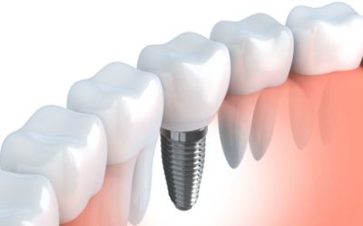 The Basics of Dental Implant Care