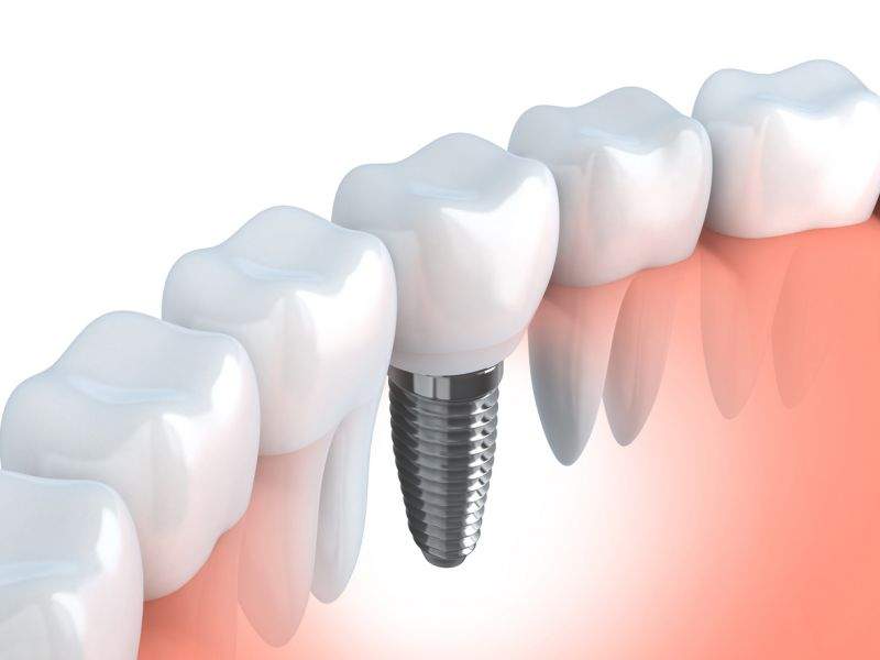 The Basics of Dental Implant Care
