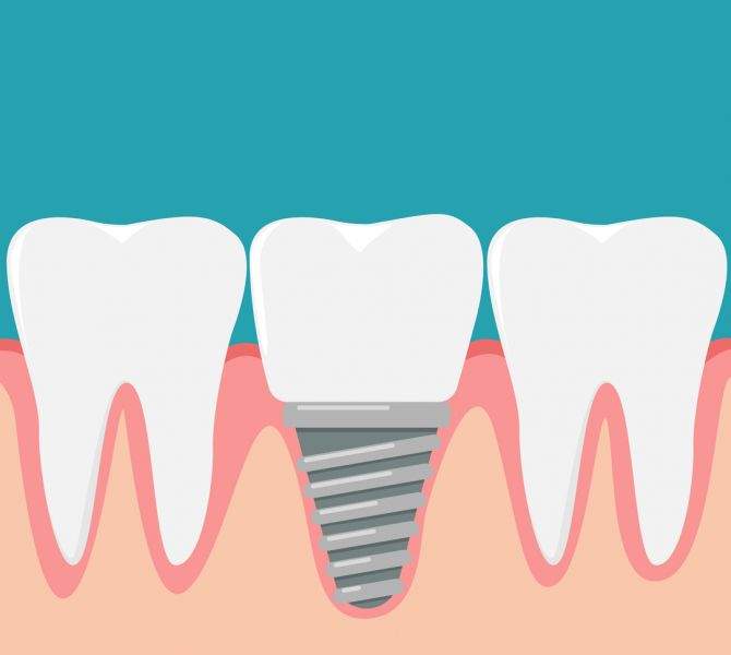 What You Should Know About Dental Implants