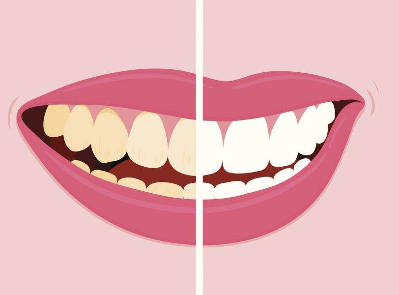 Understanding Tannins and Teeth Discolouration