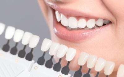Choosing the Best Teeth Whitening Option for Your Needs