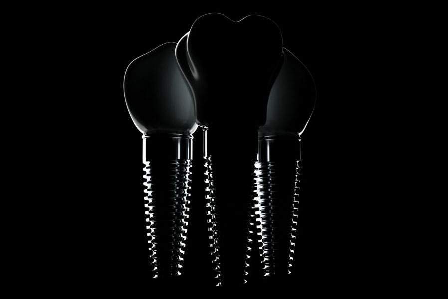 What Are Dental Implants?