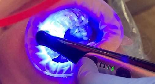 New Smile with Resin Veneers 