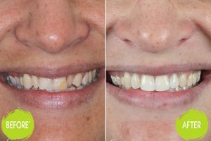 Veneers Casey Dentists 4