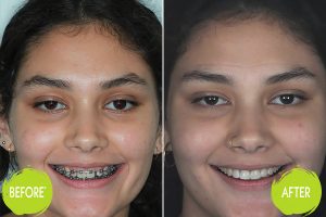 Orthodontic Braces Casey Dentists 1