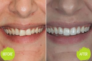 Invisalign Casey Dentists 5