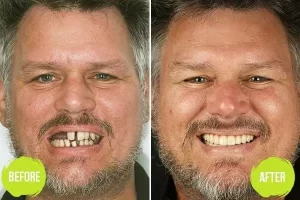 Dental Implants Casey Dentists 2