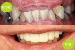 Dental Implants Casey Dentists 27