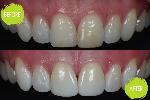 Veneers Casey Dentists 9