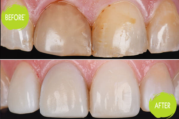 Veneers Casey Dentists 1