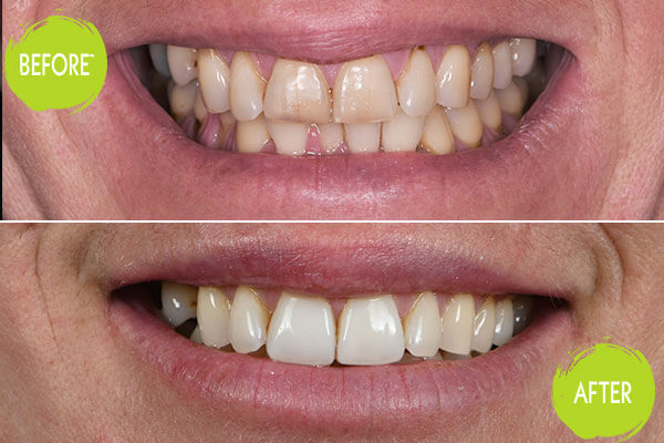 Veneers Casey Dentists 3