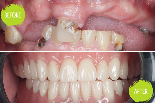 Dental Implants Casey Dentists 26