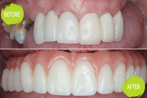 Dental Implants Casey Dentists 28