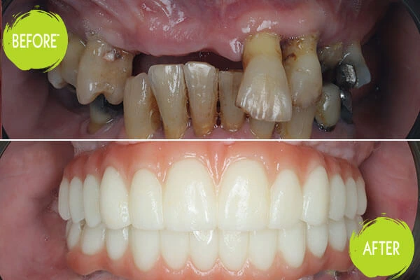 Dental Implants Casey Dentists 25