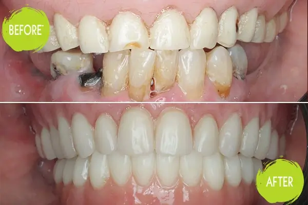 Dental Implants Casey Dentists 20