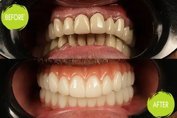 Dental Implants Casey Dentists 21