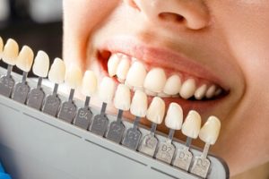 maintaining new veneers