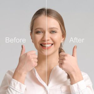 How Do Veneers Work results