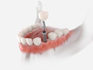 Cheapest-Dental-Implants-In-Australia-illustration