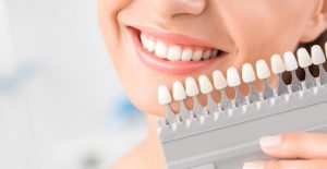 are veneers permanent colour