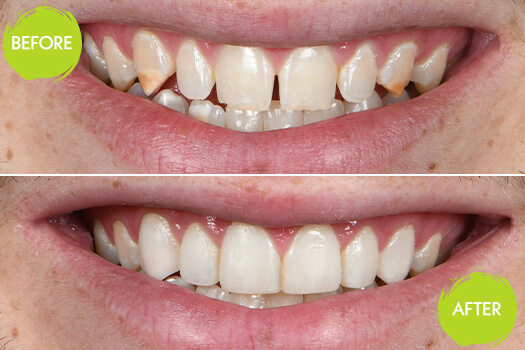 Veneers Casey Dentists 17