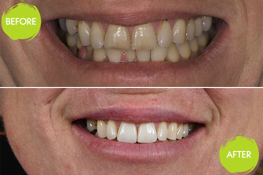 Veneers Casey Dentists 14