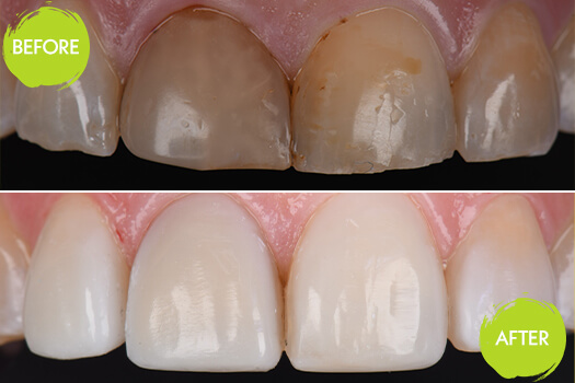 Veneers Casey Dentists 15