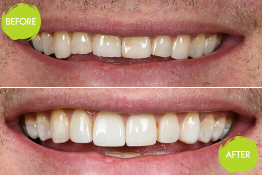 Veneers Casey Dentists 18