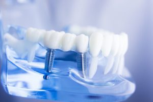 How Much for Dental Implants bridge implant townsville