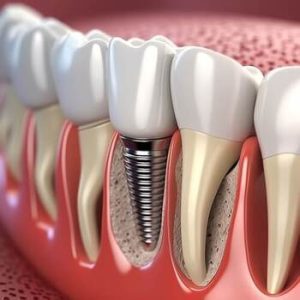 Single Tooth Implant Cost Australia image townsville