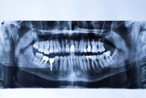 single tooth implant cost australia x-ray townsville