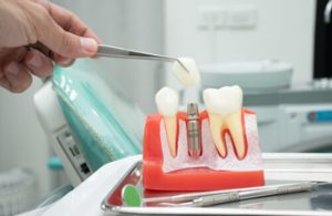 Dental Implant Thailand procedure townsville