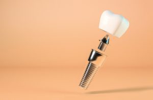 dental implant thailand type townsville