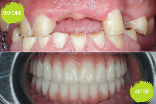 Dental Implants Casey Dentists 29