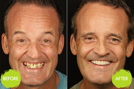 Dental Implants Casey Dentists 22