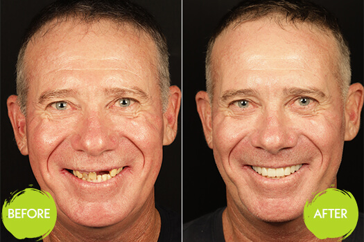 Dental Implants Casey Dentists 23