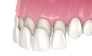 porcelain veneers cost australia application townsville