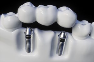 dental implants for seniors townsville