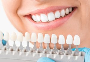 how long do composite veneers last colour townsville