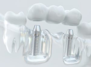 retiree dental implants townsville