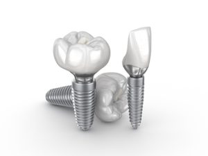 tooth implant seniors townsville