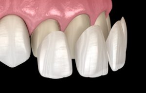 fees for veneers thailand townsville