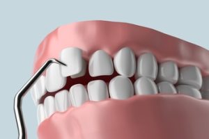 proper ways in veneers townsville