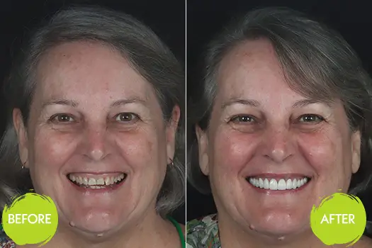 Smile Makeover Casey Dentists 1