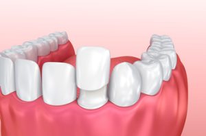 whitening veneers procedures townsvill