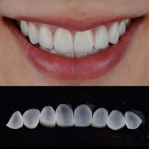 Veneers Payment Plan shells townsville