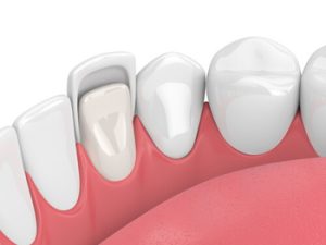 how are veneers done front teeth townsville