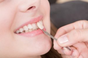 how are veneers done shell townsville