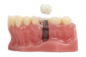 dental implant cost philippines material